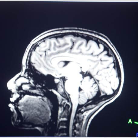 MRI Image of Brain