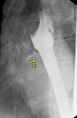 Fluoroscopy Post esophageal stent leak example