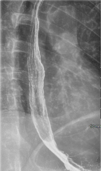 Fluoroscopy - Esophogram