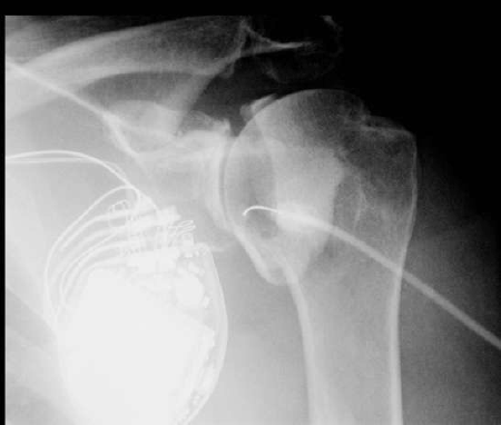 Fluoroscopy - shoulder arthrogram contrast injection fo CT