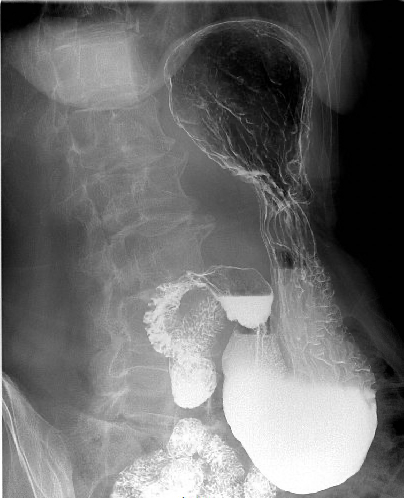 Fluoroscopy - Upper GI