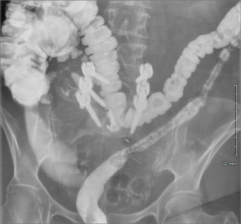 Fluoroscopy Barium Enema