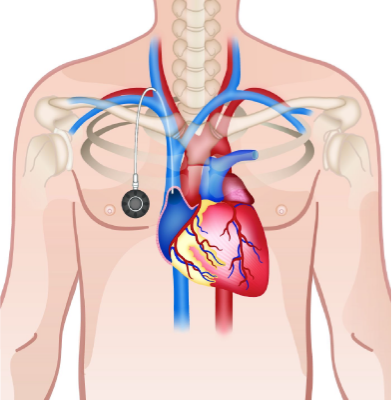 Vascular Access