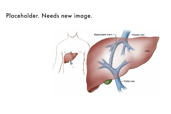 Hepatobiliary Interventions