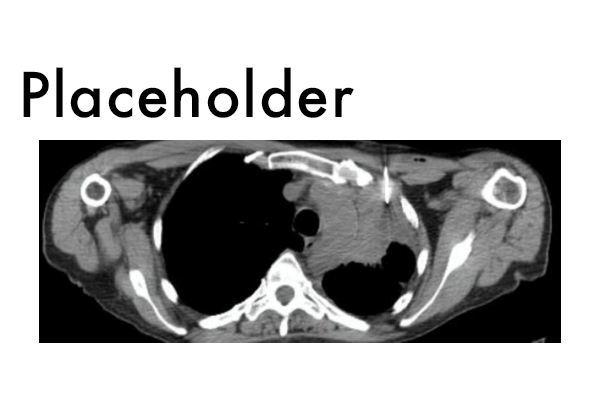 Interventional oncology placeholder