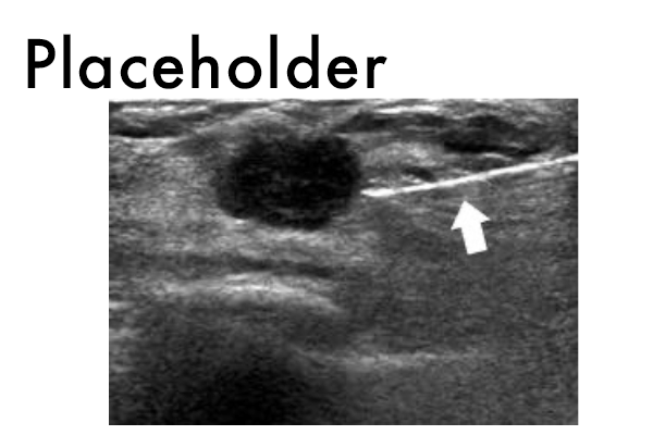 Interventional oncology placeholder