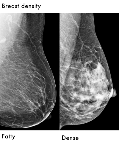 Mammography fatty and dense breast density examples