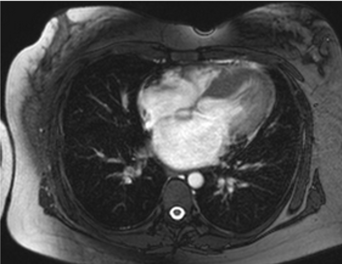 MRI of heart