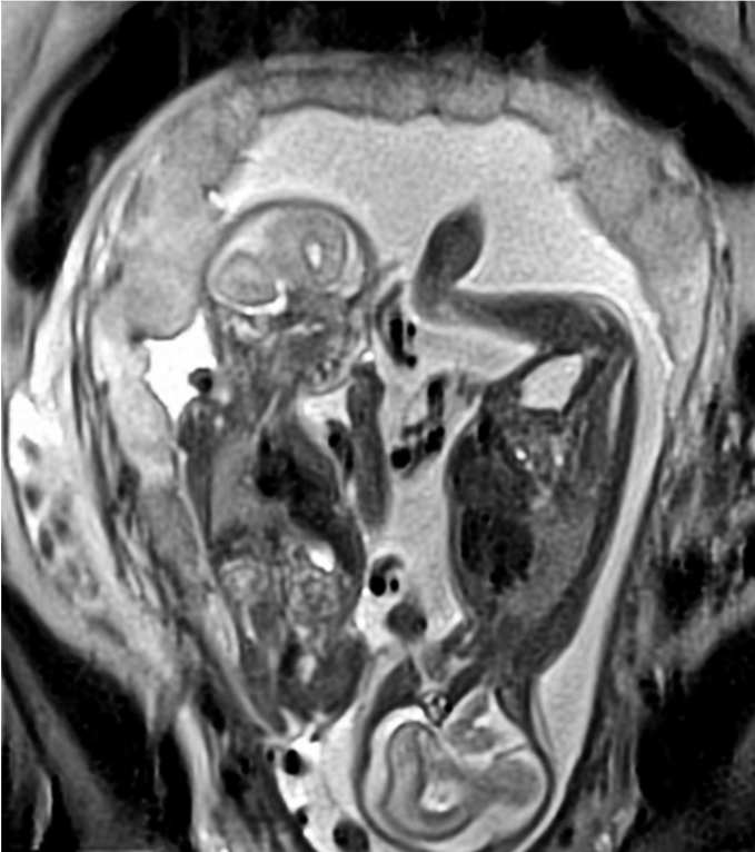 MRI of twin fetuses