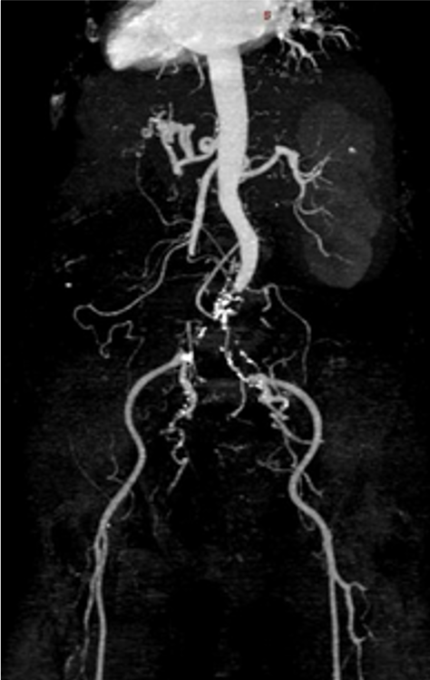 MRI of blood vessels