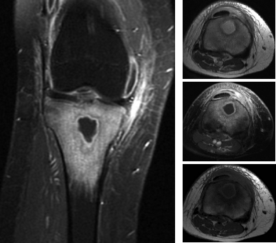 MRI image of infections in bones