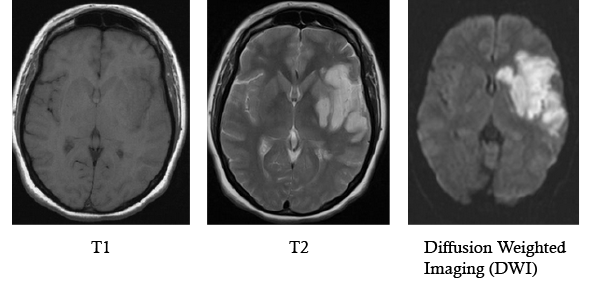 MRI in diagnosis of stroke