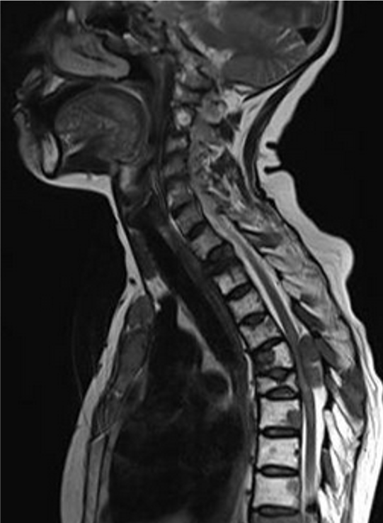 MRI of spinal cord compression