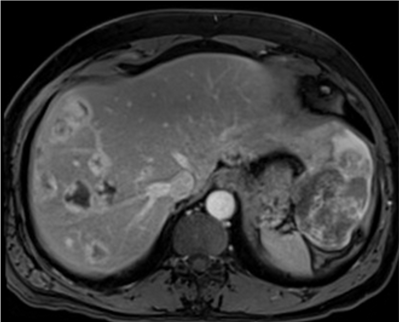 MRI image of tumors