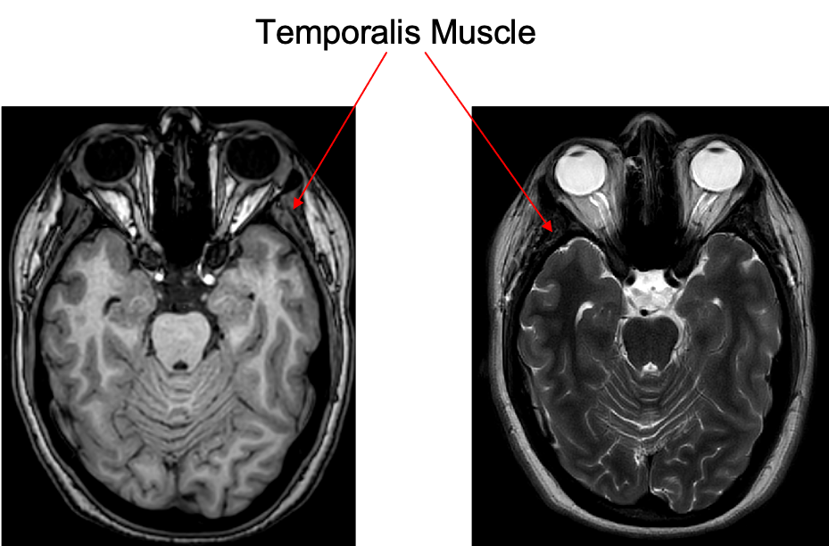 T1 and T2 weighted image representing muscle