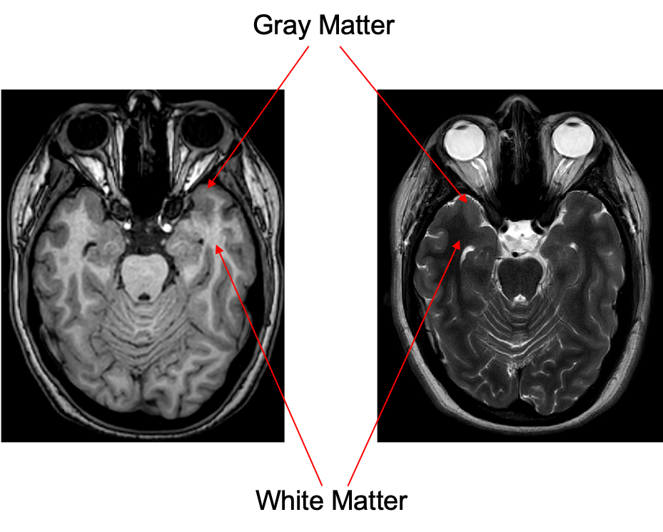 T1 and T2 weighted image representing whitematter