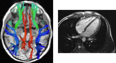 MRI of brain