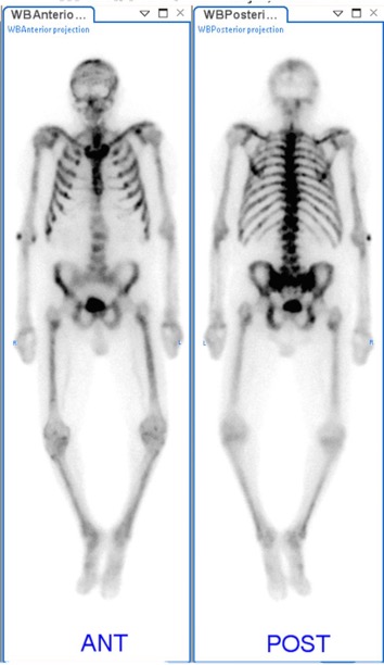 Bone scan