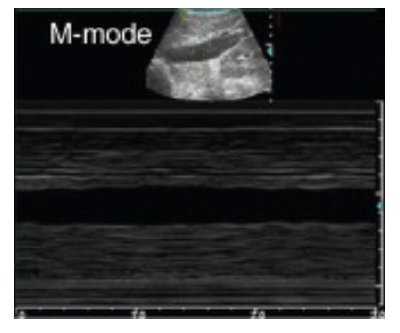 Ultrasound M-Mode