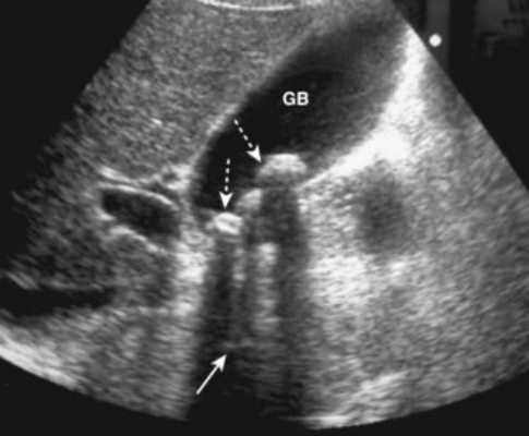 Right upper quadrant - cholelithiasis