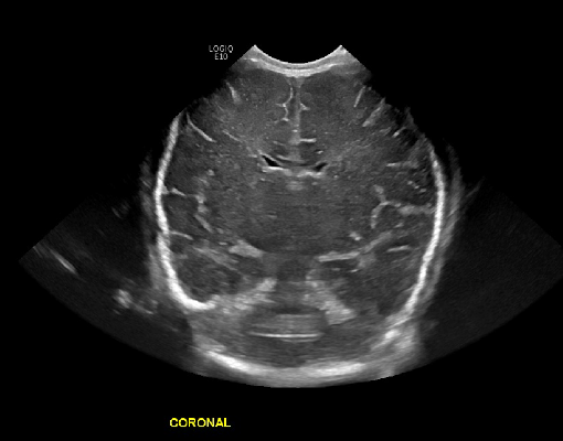 Neonatal brain ultrasound